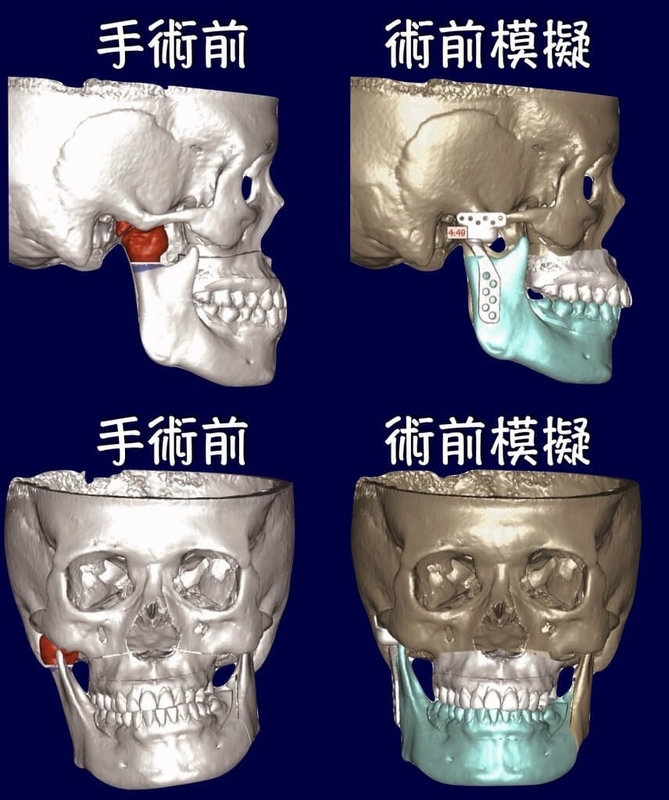 40歲女性近年下巴逐漸歪斜,影響咬合自信也受損,林口長庚檢查發現,竟是右側顳顎關節髁頭腫瘤導致;幸經腫瘤切除及人工顳顎關節置換,並結合正顎手術,解決臉部歪斜。(長庚醫院提供)中央社記者曾以寧傳真 114年4月11日