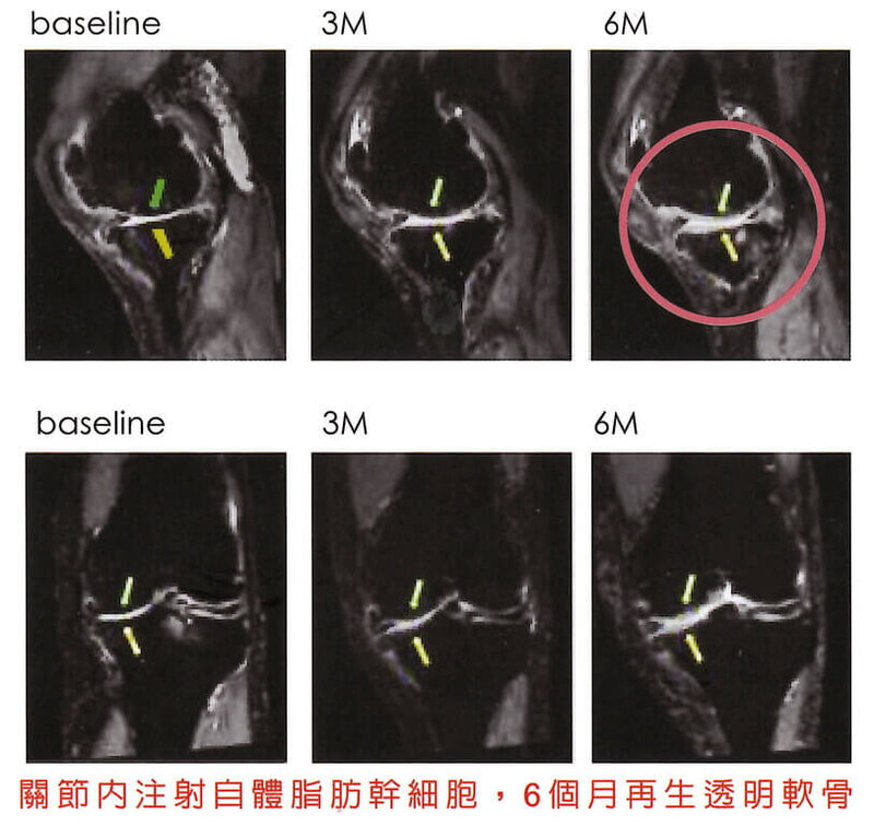 「自體脂肪幹細胞治療退化性關節炎及膝關節軟骨缺損」是透過取皮下脂肪,再經由特殊的技術,分離出脂肪幹細胞加以培養,之後再以關節注射方式治療,透過其自我更新、再生修復以及免疫調節的能力,讓受關節炎所苦的民眾重拾「膝」望。(振興醫院提供)中央社記者曾以寧傳真 114年5月6日