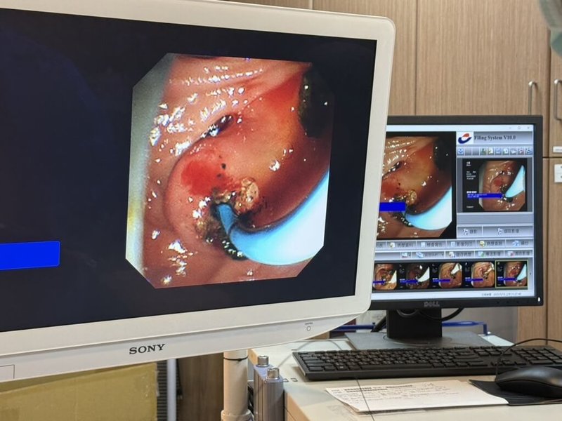 澎湖醫院日前順利完成首例內視鏡逆行性膽胰管攝影術(ERCP),為87歲老婦取出2顆結石,手術時間約50分鐘,過程順利。(衛生福利部澎湖醫院提供)中央社 114年5月15日