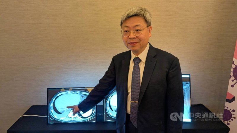 新竹台大分院副院長盛望徽(圖)7日指出,曾收治1名6旬老翁因腸胃道出血併發肝膿瘍感染,期間3度住院、歷時3個多月,使用6、7種抗生素治療卻反覆復發,醫療團隊發現老翁感染的是具金屬內醯胺酶(MBL)多重抗藥性機制的腸桿菌。中央社記者曾以寧攝 114年6月7日