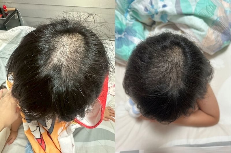 根據香港研究顯示,COVID-19疫情期間出生寶寶缺少維持腸道微生態健康天然抗菌肽基因,患上濕疹等過敏症發病率較疫情前出生的嬰兒多46%。圖為幼童使用益生菌外用產品,頭皮與髮絲狀態改善,原本容易抓癢或不適情況逐漸穩定下來。(營養師羅晞蕾提供)中央社記者陳婕翎傳真 114年6月15日