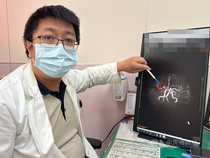 一名70多歲老翁在田裡昏倒,送醫檢查診斷為暫時性大腦缺血,是中風的前兆。大甲李綜合醫院神經內科醫師張峻誠(圖)指出,患者右中大腦動脈有阻塞現象。中央社記者趙麗妍攝 114年7月25日