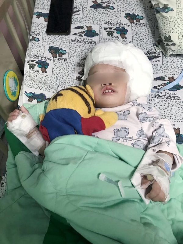 早產女孩萁萁(化名)出生當時僅1380公克,不僅有腭裂,還合併缺1顆腎臟、脊椎與胸骨發育不全、心臟破損與斜頸等多重病症,更需植入電子耳,4年過去,萁萁已歷經6次手術。(羅慧夫顱顏基金會提供)中央社記者曾以寧攝 114年8月15日