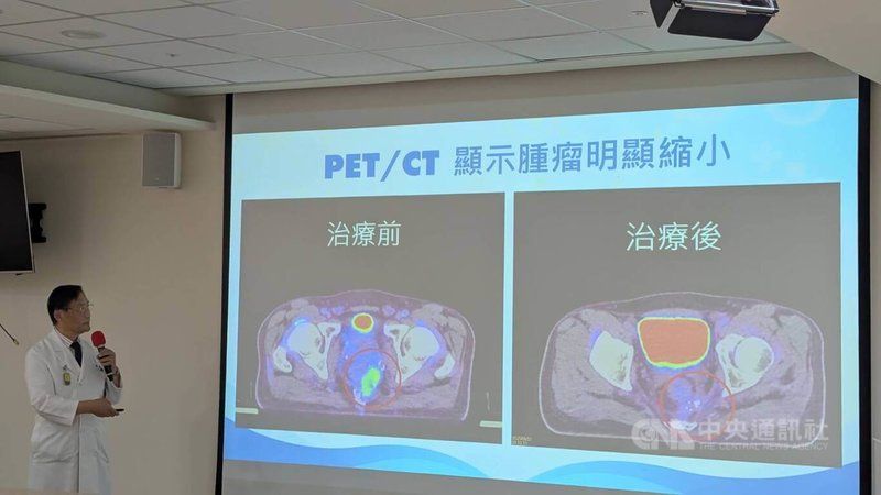 邱先生長年騎車屁股痛卻不以為意，直到因睪丸發炎就醫，才發現已惡性直腸腫瘤第3期，且復發後難再用化療與放療治療。幸在新光醫院腫瘤治療科主任季匡華（左）治療下，成功縮小腫瘤。中央社記者曾以寧攝 114年8月28日