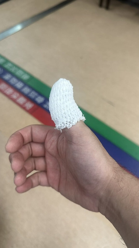 天主教耕莘醫院指出，新北市一名30歲男子日前為救一隻受困野貓遭咬，隔天傷口迅速惡化，提醒民眾若被動物抓傷或咬傷，應立即以大量清水沖洗傷口至少15分鐘，並及早就醫。（天主教耕莘醫院提供）中央社記者曹亞沿傳真　114年9月22日