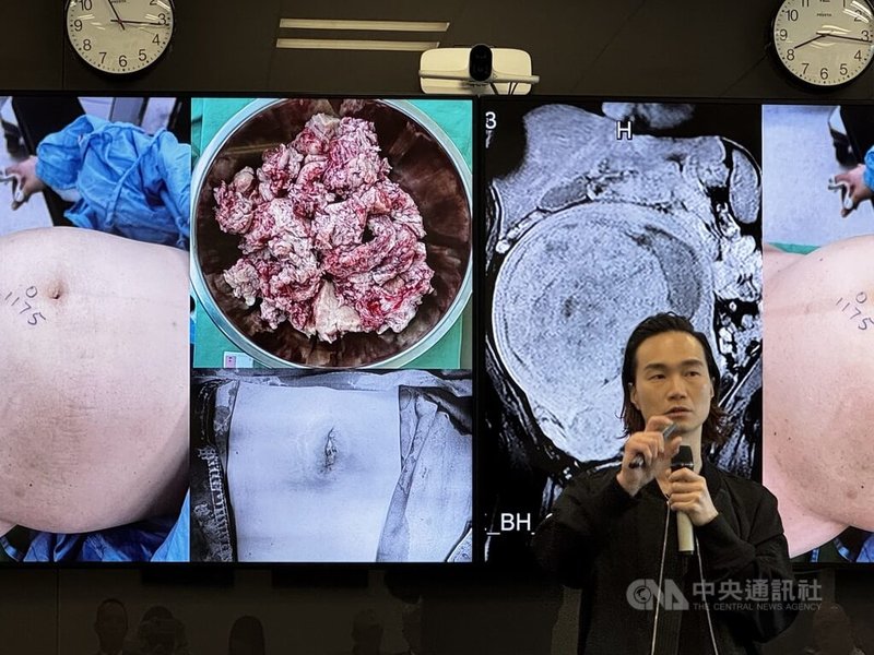 子宮肌瘤是女性骨盆腔常見腫瘤,新光醫院婦科機械手臂暨微創中心主任李偉浩15日在衛教記者會中,分享使用單孔機器手臂治療案例。中央社記者沈佩瑤攝 114年10月15日