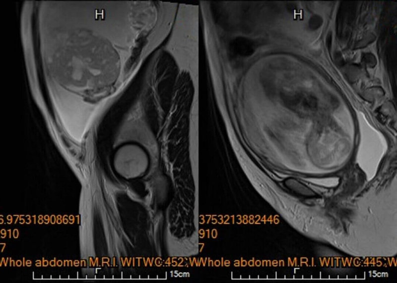 馬偕醫院指出,李小姐在妊娠20週進行第4次例行性產檢時,醫師發現其腹腔內積滿大量腹水,及左側下腹部有一個15公分大小、邊界模糊、結構複雜的卵巢腫瘤。 (馬偕醫院提供) 中央社記者陳婕翎傳真 114年10月28日