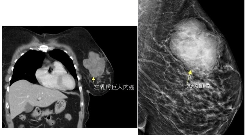 苗栗有婦人單側乳房出現硬塊,就醫檢查出近10公分大腫瘤,手術切除病理報告並非臨床常見的乳腺癌,而是發生率低且罕見出現在乳房部位的肉癌。(大千綜合醫院提供)中央社記者管瑞平傳真 114年10月29日