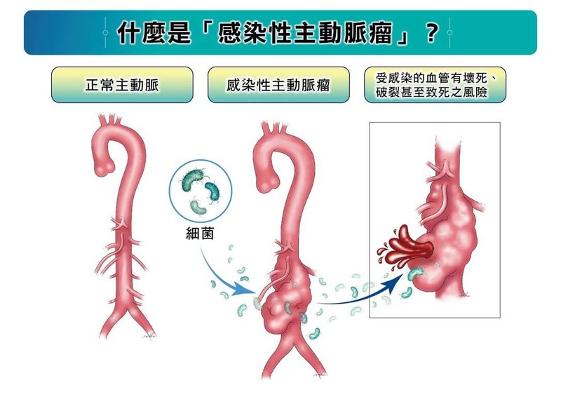 感染性主動脈瘤是由細菌等病原體入侵主動脈,導致血管壁壞死、破裂的罕見疾病,若未即時治療,死亡風險極高。(長庚醫院提供)中央社記者曾以寧傳真 114年10月31日