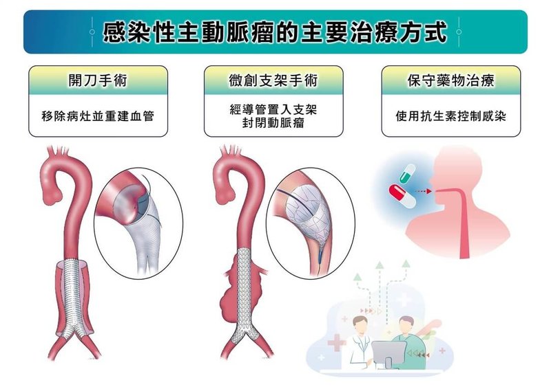感染性主動脈瘤的3種主要治療方式,包含開刀手術、血管內微創修補以及保守藥物治療,不同方法各有適用情況,醫師會依病人的整體健康狀況與疾病特性,選擇最合適的治療方案。(長庚醫院提供)中央社記者曾以寧傳真 114年10月31日