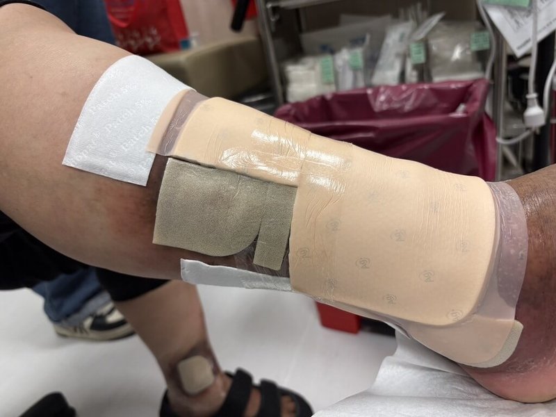 新竹縣58歲婦人因靜脈曲張，反覆治療未癒合，中國醫藥大學新竹分院前心臟外科主任翁啟峰6日表示，患者右腿小隱靜脈逆流導致血流鬱積，經雷射封閉手術與清創合併防水敷料治療康復。（翁啟峰提供）中央社記者郭宣彣傳真 114年11月6日