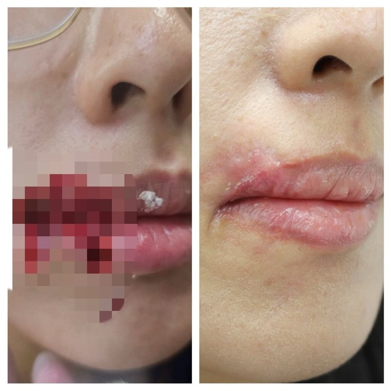 28歲胡姓女子日前遭愛犬咬掉嘴邊肉，衛福部豐原醫院團隊啟動急救流程，進行大量沖洗、清創及縫合，採「PRP（自體血小板血漿）增生療法」成功修復臉部。（豐原醫院提供）中央社記者趙麗妍傳真　114年11月17日