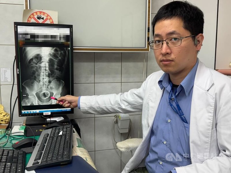 李綜合醫院外科醫師吳坤達20日表示，患者就醫發現肛門塞了一個陶瓷杯，經手術把塞在肛門的杯子取出，提醒相關案例可能引發腹腔感染，併發腹膜炎，有致死危機。中央社記者趙麗妍攝　114年11月20日