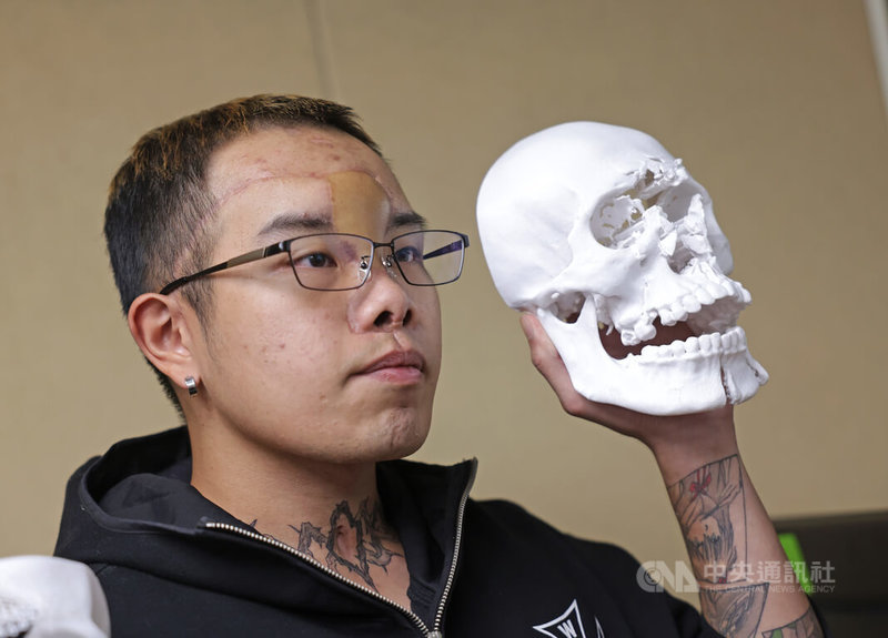 三軍總醫院日前接獲遭槍傷導致臉骨粉碎、腦部直接暴露的患者,透過3D列印模型輔助手術規劃,成功讓患者重獲自然五官比例,26日並邀請重建滿1年、順利重回社會的患者出席治療成果發表記者會。中央社記者裴禛攝 114年11月26日