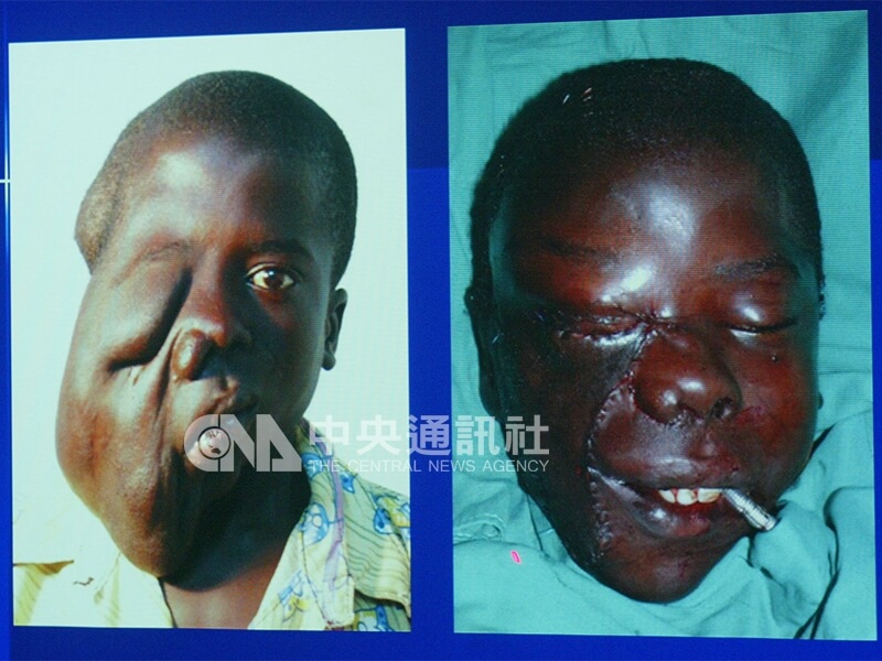 二度在台治療復健的神經纖維瘤患者「非洲阿福」凱博文森，經過長庚醫療團隊多年的手術治療，外觀改善許多，也建立了自信心。中央社記者徐肇昌攝　96年2月9日