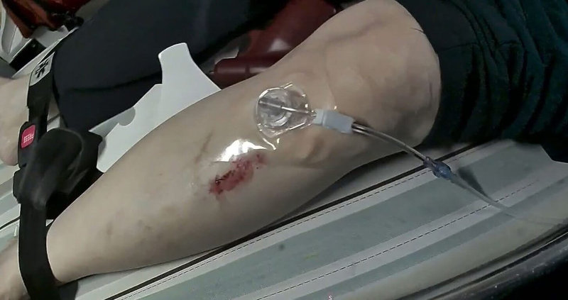 苗栗縣消防局卓蘭分隊民國114年底執行一起路倒救護案件，到場發現患者已無呼吸心跳，立即使用「骨針」急救注射腎上腺素送醫，患者經治療後順利康復，成縣內高級救護技術員以骨針急救成功康復出院首例。（苗栗縣消防局提供）中央社記者管瑞平傳真　115年1月7日