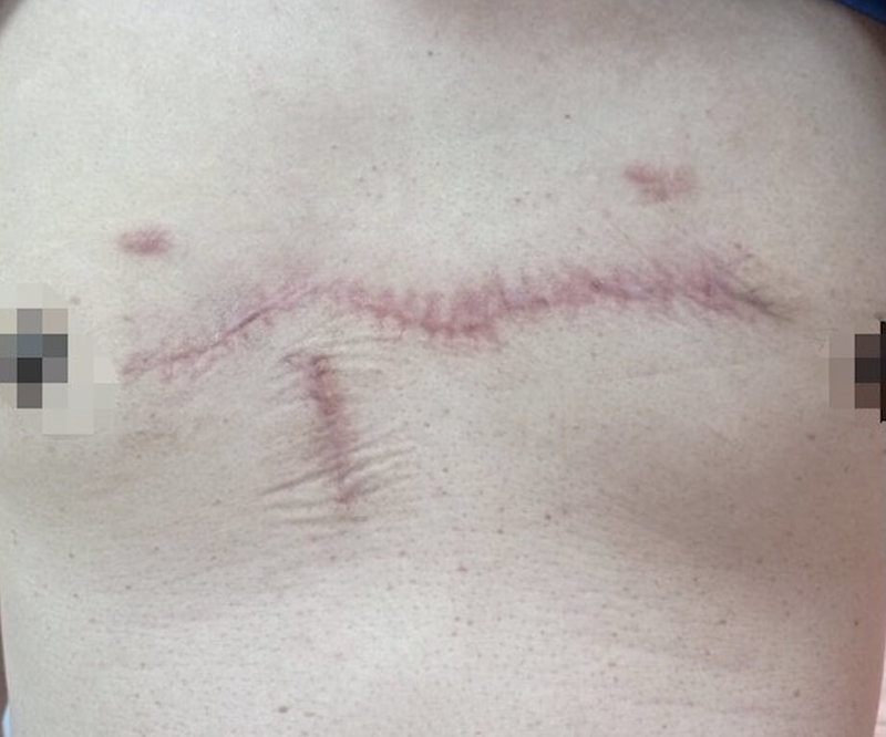 20多歲李姓男子胸部長小青春痘，擠破後傷口卻無法癒合，增生為長10多公分、寬5公分疤痕，且會發癢疼痛。員榮醫院整形外科醫師診斷為蟹足腫，經手術切除後再用生物膜覆蓋縫入傷口，情況已明顯改善。（員榮醫院提供）中央社記者吳哲豪傳真　115年1月9日