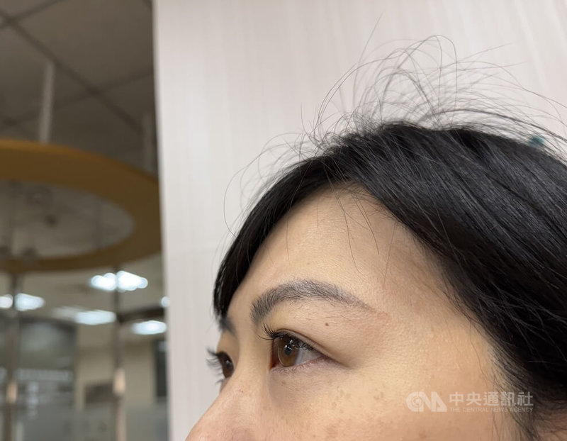 每年農曆過年前是民眾「進廠修修臉」高峰期，醫師提醒，眼皮上發現影響美觀的「黃色瘤」，這其實是身體脂質代謝異常的「求救訊號」，若沒有從控制血脂根本做起，最嚴重恐引發心肌梗塞、腦中風等致命危機。（示意圖）中央社記者沈佩瑤攝　115年1月10日