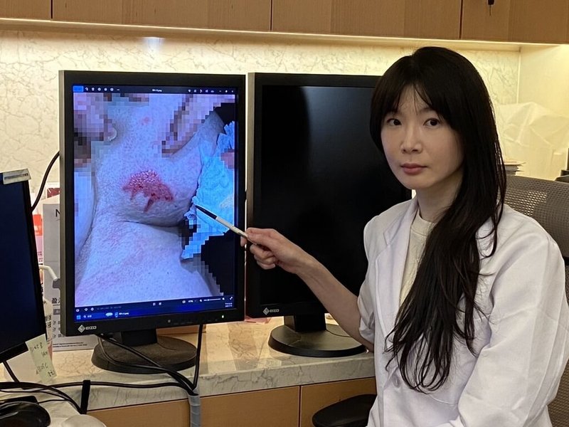 近日氣溫驟降，台中茂盛醫院皮膚科醫師鍾佩宜21日指出，有女子將暖暖包放在胸口抗寒，9個小時後取下，發現左乳泛紅皮膚已脫落，緊急就醫；建議選用溫度較低貼膚性暖暖包，避免燙傷。（茂盛醫院提供）中央社記者郝雪卿傳真  115年1月21日