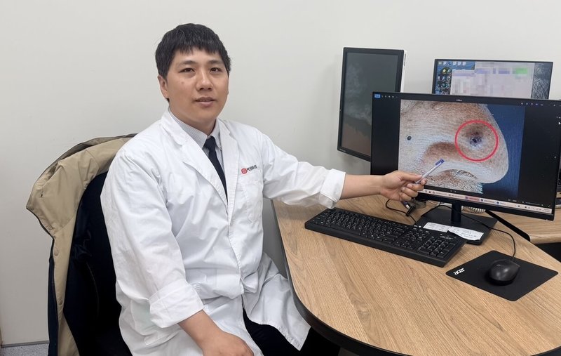 光田綜合醫院皮膚科醫師何英右（圖）指出，70歲陳姓老翁起初只是鼻部出現一顆突出一公分如同痣般的小黑點，不痛不癢，沒有不適卻慢慢變大，切片檢查確認為「基底細胞癌」。（光田綜合醫院提供）中央社記者趙麗妍傳真 115年1月22日