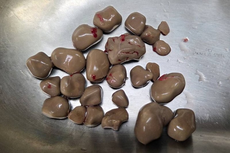 嘉義一名8旬老翁因排尿困難就醫，透過X光檢查發現膀胱內一堆大小結石，經手術後共取出24顆光滑如鵝卵石的結石，醫師研判應是喝水過少導致。（黃才倍提供）中央社記者蔡智明傳真　115年1月30日