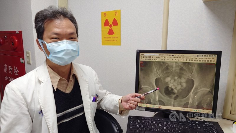 嘉義一名8旬老翁日前因排尿困難到嘉義市陽明醫院就醫，醫師黃才倍（圖）安排照X光，於老翁膀胱發現20幾顆大小結石，後續以手術取出，老翁恢復良好。中央社記者蔡智明攝　115年1月30日