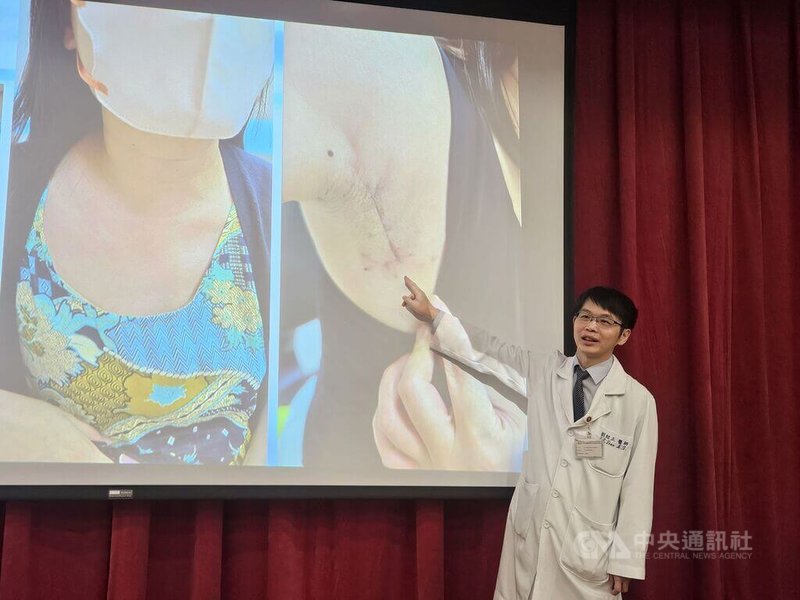 三軍總醫院耳鼻喉科部主治醫師劉紹正（圖）4日表示，不少年輕女性甲狀腺癌患者在意傳統手術會於頸部留下傷疤，他建議可與醫療團隊討論採遠端切口，將疤痕從脖子轉移腋下等處。中央社記者陳婕翎攝　115年2月4日