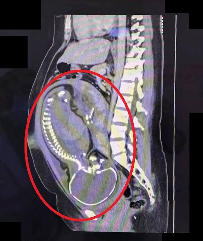 苗栗縣懷孕39週孕婦腹痛前往大千醫院急診，診斷為急性盲腸炎，因胎兒已近足月，經婦產科與一般外科合作緊急進行剖腹生產併盲腸切除手術，順利產下男嬰。（大千醫院提供）中央社記者管瑞平傳真　115年2月10日