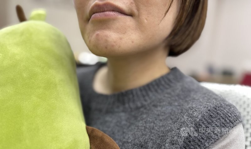農曆新年親友聚會，打牌、聊天常常不小心就通宵，皮膚科醫師呼籲，民眾應落實保濕、睡飽覺、避開特定食補，才不會一收假就去皮膚科報到。圖為問題皮膚示意照。中央社記者沈佩瑤攝　115年2月16日