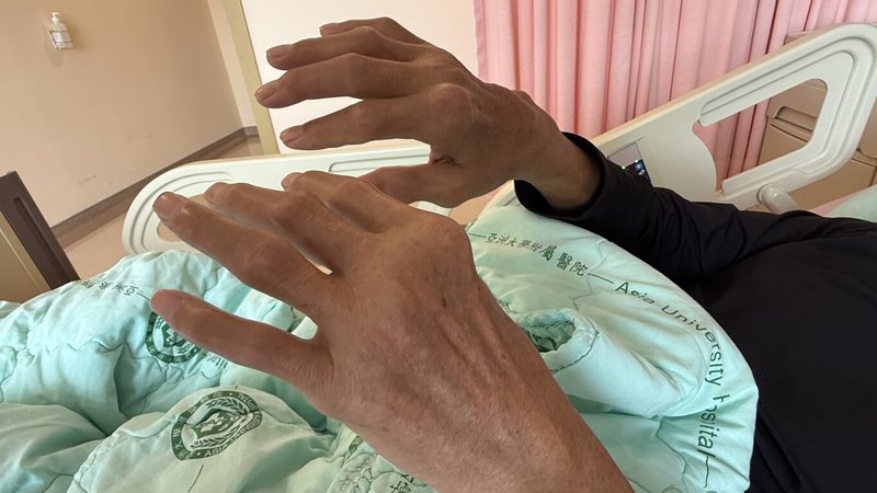 台中黃姓男子長年患有痛風未控制，因長時間尿酸失控下，尿酸結晶不斷沉積於關節與周邊軟組織，逐漸形成一顆顆肉眼可見的痛風石，明顯分布於手指、手腕等處。（亞大醫院提供）中央社記者蘇木春傳真　115年3月17日
