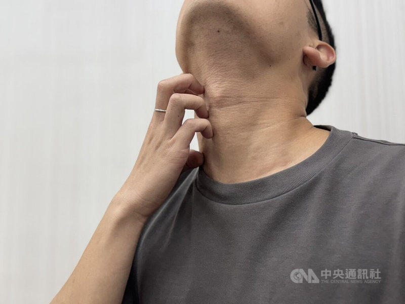 隨著清明節氣來臨，氣候由乍暖還寒逐漸轉為溫暖潮濕，中醫師指出，此時正是皮膚問題好發季節，尤其是濕疹、異位性皮膚炎、皮膚搔癢等症狀。中央社記者沈佩瑤攝　115年4月4日