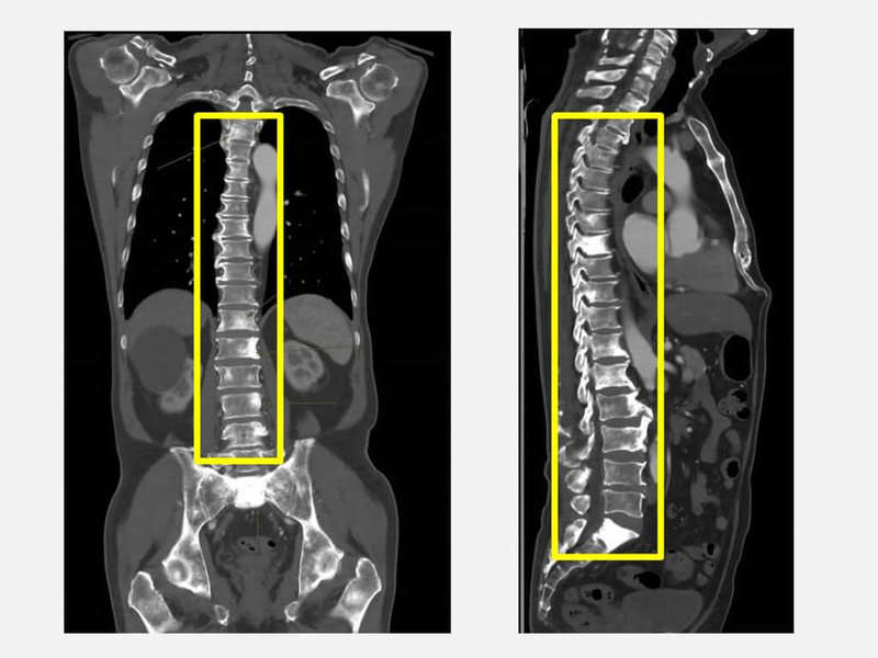 台中余姓男子近日背痛嚴重，到醫院健檢發現攝護腺特異抗原等指數偏高，檢查確診攝護腺癌合併骨轉移（方框處），經治療病情獲得控制。（大里仁愛醫院提供）中央社記者蘇木春傳真　115年4月7日