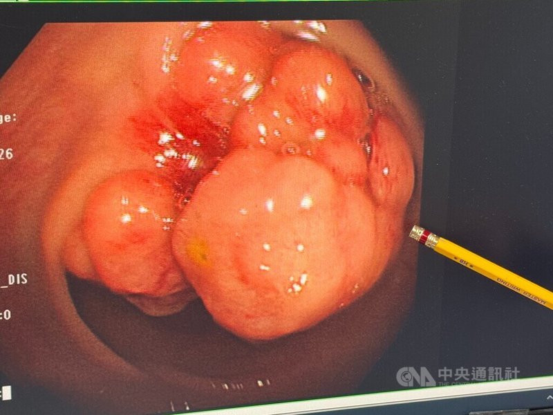 60多歲的婦人3個月來體重狂掉10公斤，腹部出現脹痛且不斷拉肚子，就醫接受大腸鏡檢查，在距肛門口50公分的地方，發現一個腫瘤。中央社記者趙麗妍攝　115年4月10日