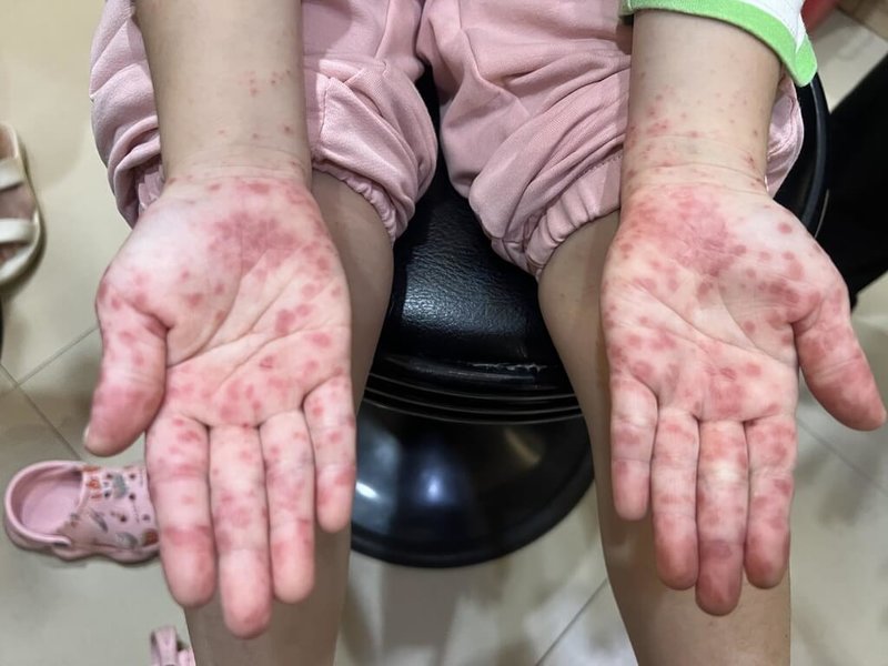 腸病毒疫情升溫，感染腸病毒患者出現手足口症，手掌長滿水泡。（兒科醫師施勝桓提供）中央社記者趙麗妍傳真　115年4月24日