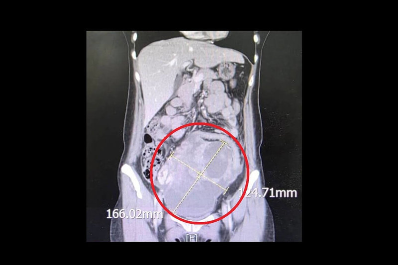 苗栗一名女子長時間感到腹痛、腹脹且食慾不振，以為腸胃不適就醫，意外發現腹部有直徑達16公分腫瘤，化驗確診罕見的同步性子宮內膜癌和卵巢癌。（大千醫院提供）中央社記者管瑞平傳真　115年4月28日