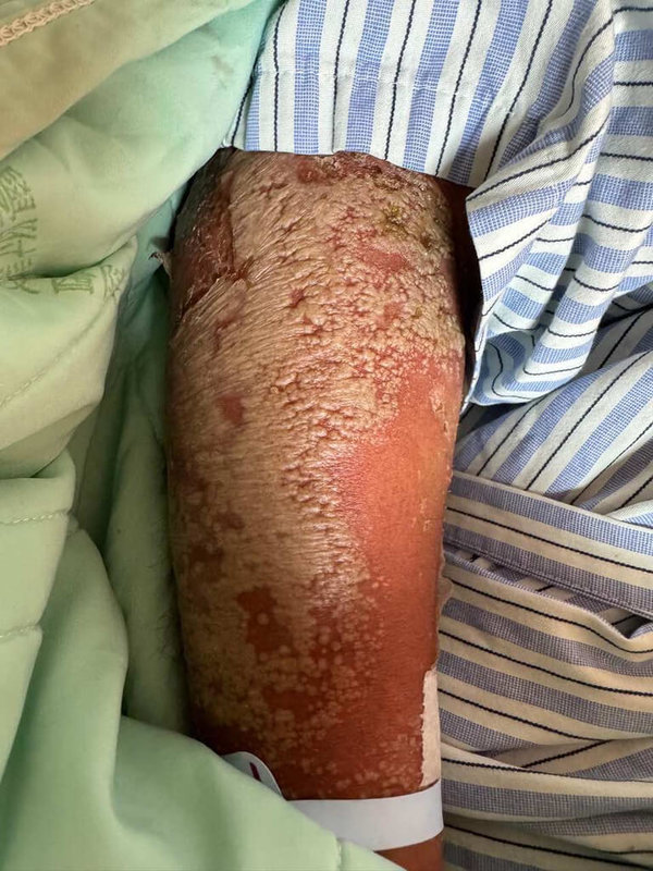 中山醫學大學附設醫院28日發布罕見病例，1名患者幼年即患有乾癬性關節炎且穩定治療，日前卻突發嚴重全身性膿疱乾癬，最終確認是基因突變及感染COVID-19交互作用下誘發。（中山醫大附醫提供）中央社記者郝雪卿傳真  115年4月28日