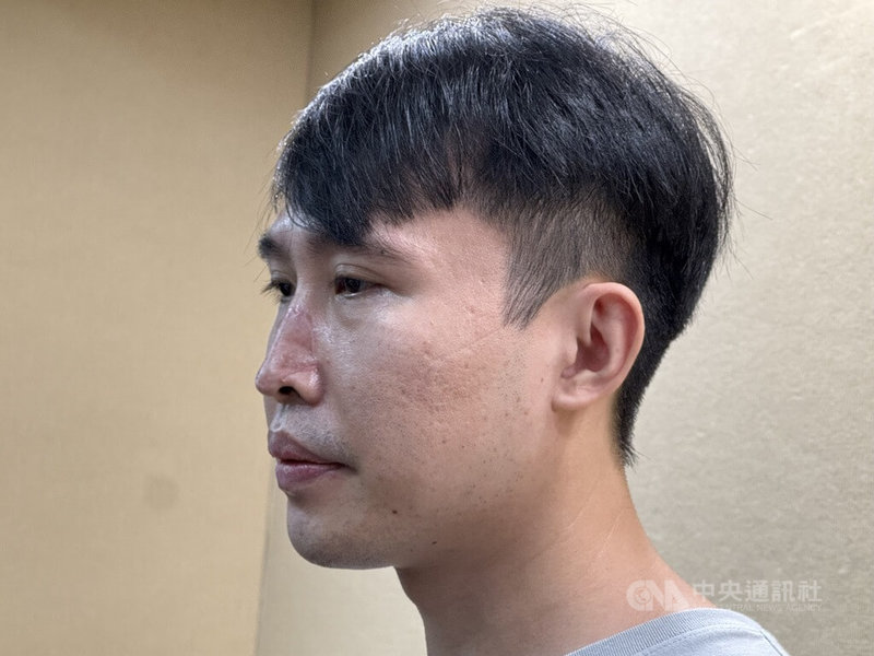 林姓男子(圖)以為鼻翼上只是長了白斑,就醫竟確診基底細胞癌。所幸在台北榮總接受兩階段「緩慢莫氏顯微手術」後,成功完整切除癌細胞,保住鼻部外觀。中央社記者沈佩瑤攝 115年7月1日