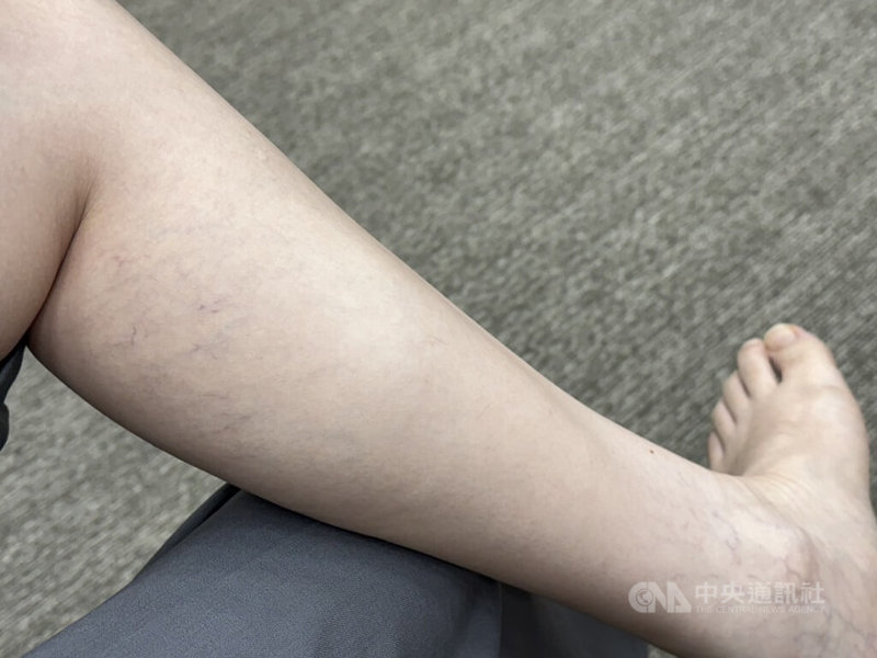 70歲林姓婦人雙腿靜脈曲張逾20年，因不痛不癢而未積極處理。近期幫忙顧孫，每天長時間站立抱哄，雙腿突痛到不能走，就醫才知是靜脈曲張惹禍。醫師提醒，靜脈曲張可能是血栓前兆勿輕忽。中央社記者沈佩瑤攝　115年8月16日
