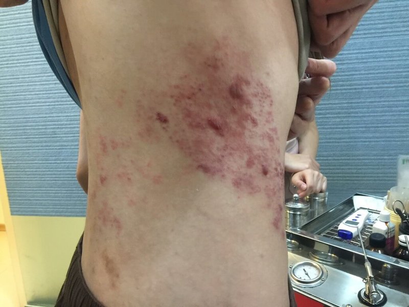 家醫科醫師施勝桓指出，帶狀皰疹是人體過去感染水痘後，病毒長期潛伏在體內，一旦免疫力下降時就會重新活化復發，曾得過水痘者都有罹患帶狀皰疹的風險；最有效的方式是接種疫苗，搭配充足睡眠、規律運動與均衡飲食。（施勝恒提供）中央社記者趙麗妍傳真　115年8月27日