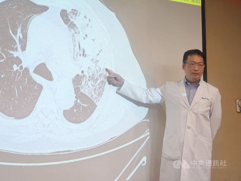 三軍總醫院感染及熱帶醫學科主治醫師吳瑞欣（圖）16日分享近期臨床特殊案例，為一名71歲男性左肺大片肺炎，但傳統檢驗未能明確找出病原，經快速PCR才找出退伍軍人菌，目前患者已於治療後順利出院。中央社記者陳婕翎攝　115年9月16日