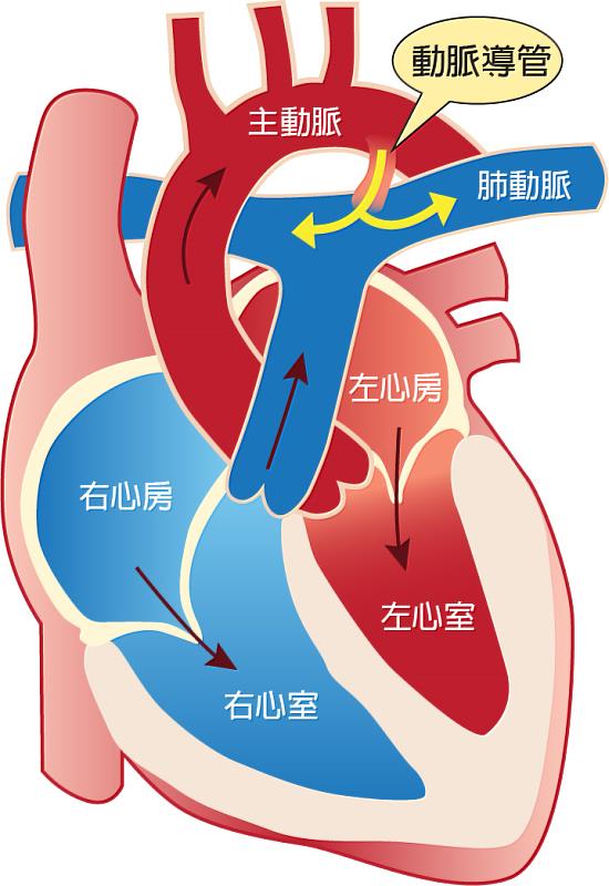 主動脈與肺動脈之間相通的血管稱為動脈導管，一般在寶寶出生後二至三天會進行功能性閉鎖，開始了由肺部呼吸的肺循環，若未關閉，部份壓力較高的主動脈血液會流入肺動脈，加入肺循環而引起肺充血，稱為「開放性動脈導管」。