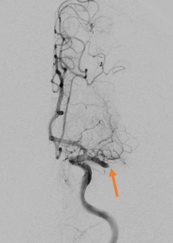 高鴻文主任在「2021台灣醫療科技展」中，以「微創介入性腦中風治療」為題在花蓮慈院攤位專家講座上分享，透過微創取栓手術，可以看出取栓前血管阻塞，取栓後血流開始暢通。