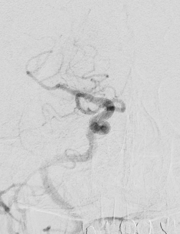 高鴻文主任在「2021台灣醫療科技展」中，以「微創介入性腦中風治療」為題在花蓮慈院攤位專家講座上分享，透過微創取栓手術，可以看出取栓前血管阻塞，取栓後血流開始暢通。