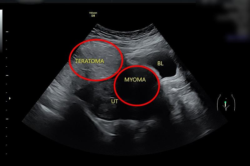 婦科超音波顯示陳小姐同時有子宮肌瘤(右圈)及卵巢瘤(左圈)。