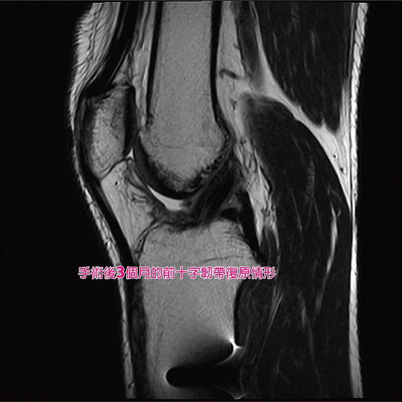 病人前十字韌帶重建手術後三個月的磁振造影檢查(MRI) 影像。