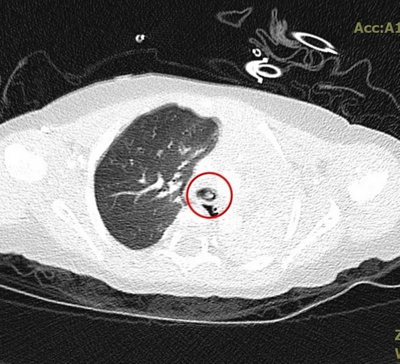 團隊進一步做電腦斷層排查原因，發現是卡在左支氣管入口的異物使氧氣無法進入左肺部。
