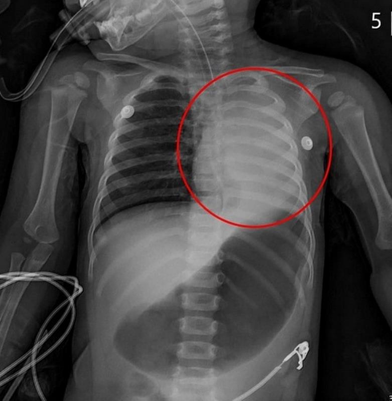 X光影像顯示孩子的左邊肺部已經呈現白色塌陷狀態。