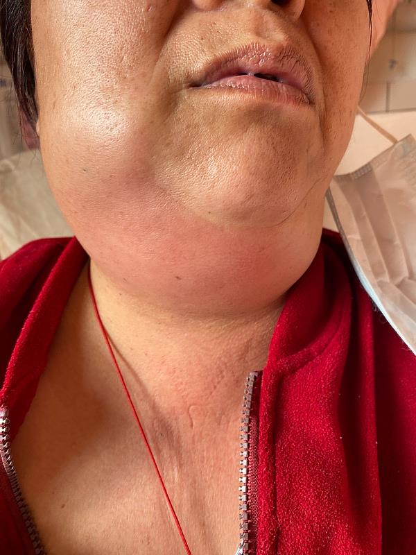 年近五旬鄭女士，拔牙後發燒、頸部腫痛，到花蓮慈濟醫院急診就醫，確診後為深頸部感染，致死率高達五成。