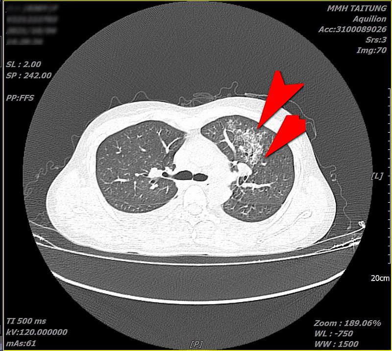 花蓮慈院日前收治一位女性恙蟲病病患，經過詳細檢查後發現她的右邊腰部有「焦痂傷口」，且肝功能指數異常，雙側鼠蹊部亦見淋巴結腫大，胸部電腦斷層檢查更發現左邊肺部有非典型發炎現象。