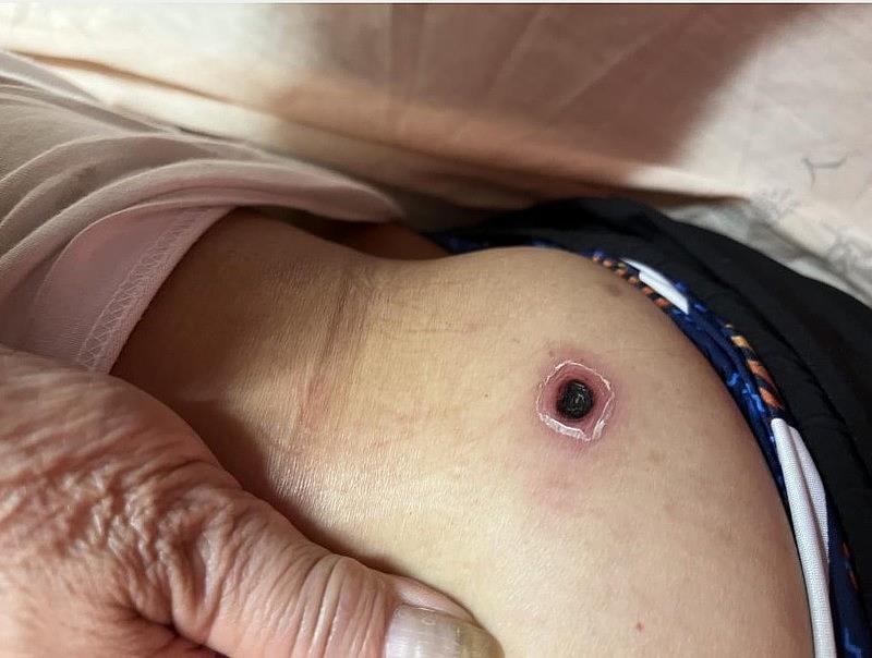 鄭順賢醫師說，大部分的人被恙蟲叮咬後，無痛無癢，叮咬處會漸漸形成中間黑色、外紅的焦痂，這是恙蟲病非常典型的皮膚特徵。